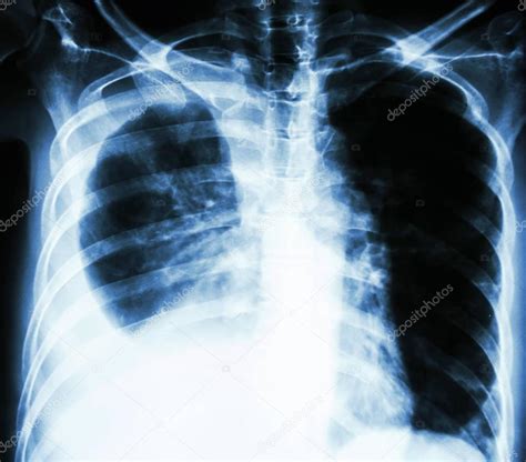 derrame pleural debido a cáncer de pulmón 2024