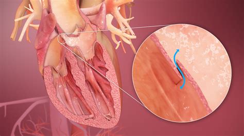 Atrial Septal Defect described breifly using 3D medical animations