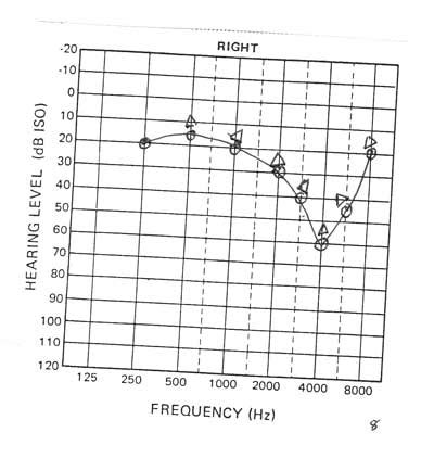 How To Read An Audiogram Conductive Sensorineural : Conductive Hearing ...