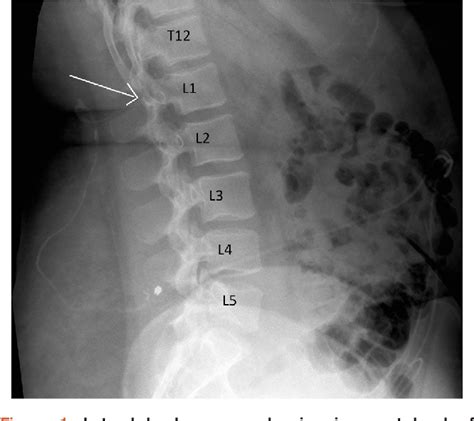 Table 1 from Lumboperitoneal shunt insertion without fluoroscopy ...