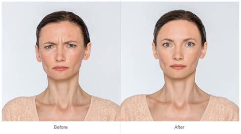 Botox Alternatives | Dysport & Xeomin | Similarities and Differences