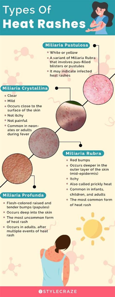 Types Of Heat Rash Heat Rash Types Of Rashes Dry – NBKomputer