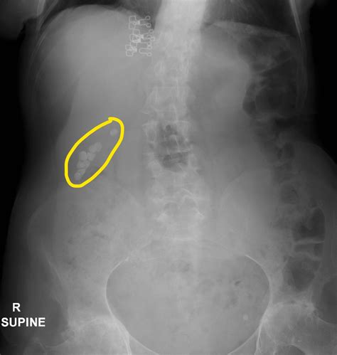 Choledocholithiasis x ray - wikidoc