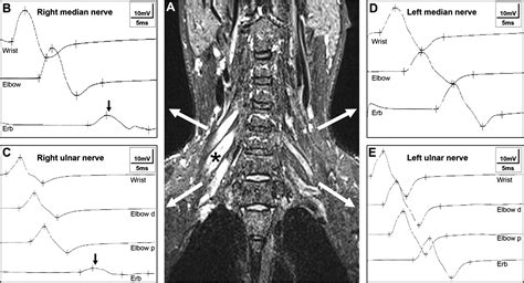 Seeing the blocks: MRI of the brachial plexus in multifocal motor ...