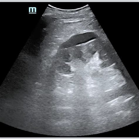 Right kidney in long-axis, after drainage of perinephric abscess ...