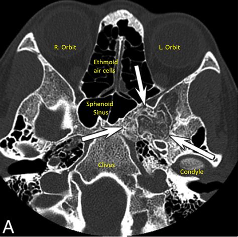 Arrested Pneumatization of the Sphenoid Sinus - Radiodontics