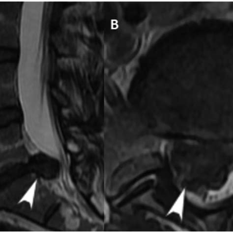 Discectomy of L5-S1 extruded disc. | Download Scientific Diagram