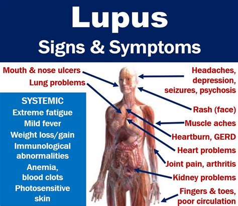 Lupus signs and symptoms with full description of features