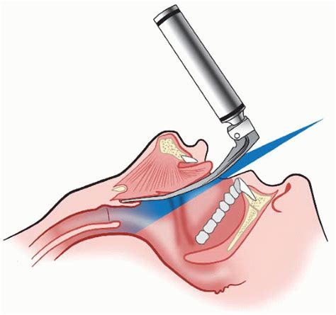 Direct Laryngoscopy | Anesthesia Key