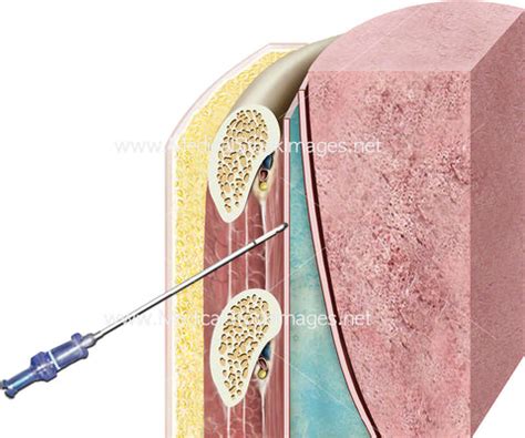 Pleural Biopsy Procedure – Medical Stock Images Company