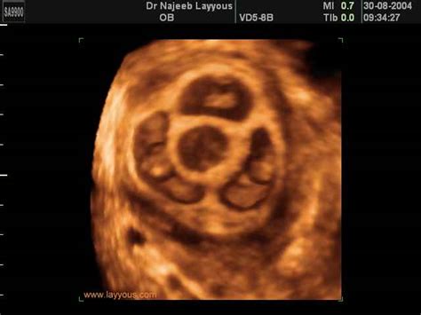 3D Ultrasound Scan photos of Multiple Pregnancy twins triplets ...