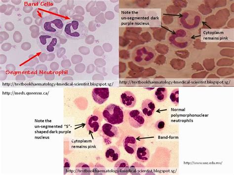 Haematology in a NutShell: Band-Form Neutrophils