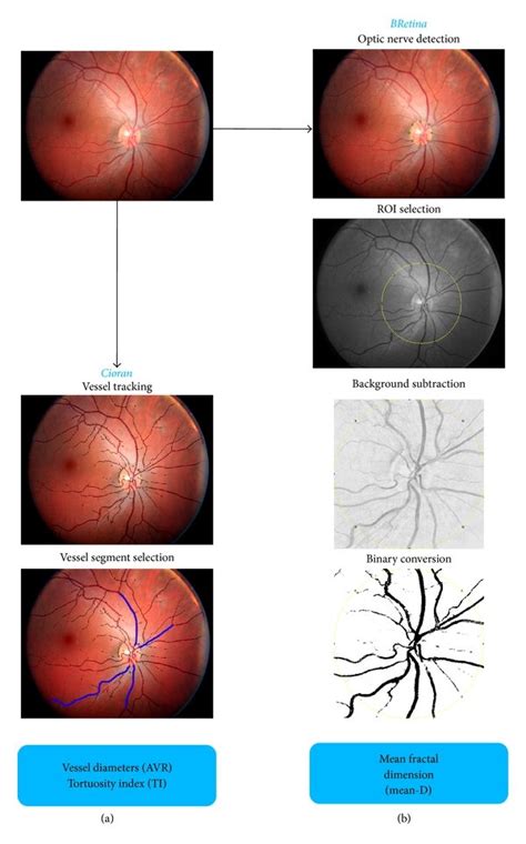 Main steps of the image processing. From an individual retinal ...