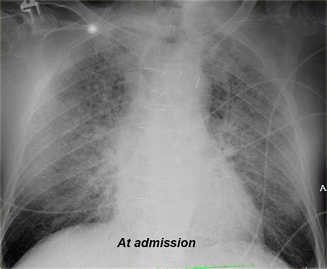 The Radiology Assistant : Chest X-Ray - Heart Failure