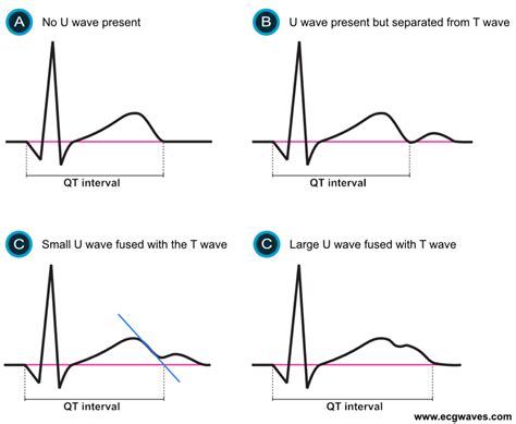 Qtc Normal Range