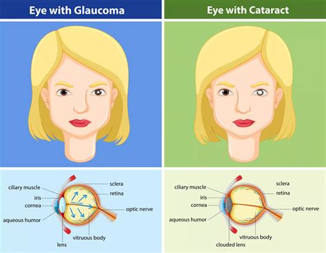 Glaucoma vs. Cataracts: What’s the Difference? - Responsum Health