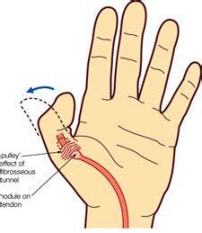 I think i have a trigger thumb – what can i do about it – Artofit