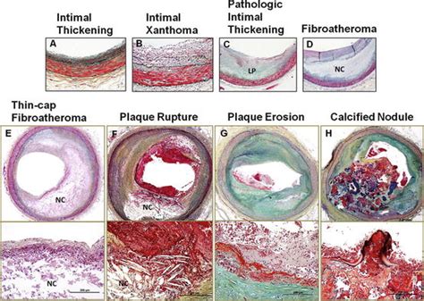 Histopathology of Atherosclerosis Progression: What Imagers Need to ...