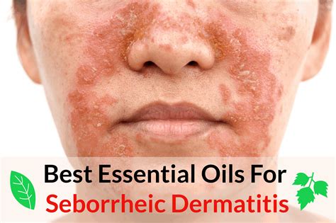 12 Essential Oils for Seborrheic Dermatitis | Essential Oil Benefits