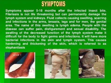 Elephantitis Elephantiasis Symptoms Treatment Pictures