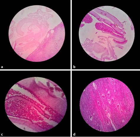 Histopathological overview of the renal hydatid cyst. a Low-power view ...