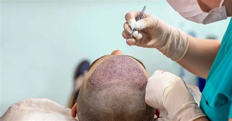 FUE Hair Transplant: What to Expect, Cost, Pictures, and More