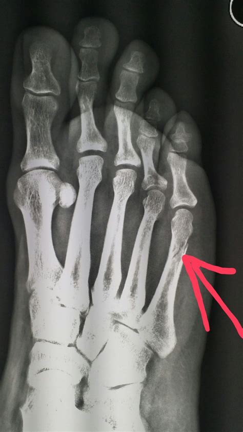 #Foot #xray shows a #fracture of the fifth #metatarsal #bone after # ...