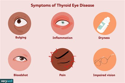 Thyroid Eye Disease: Symptoms, Causes, Diagnosis, and Treatment