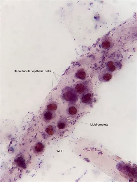 Urine Sediment of the Month: Renal Tubular Epithelial Cells - Renal ...