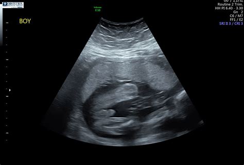 30 Weeks Pregnant Ultrasound Boy