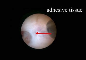 Hysteroscopic Intrauterine Adhesiolysis Using a Blunt Spreading ...