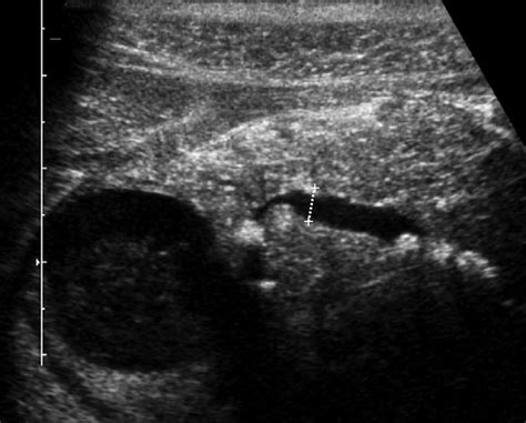 6. Transabdominal ultrasound showing typical changes of chronic ...