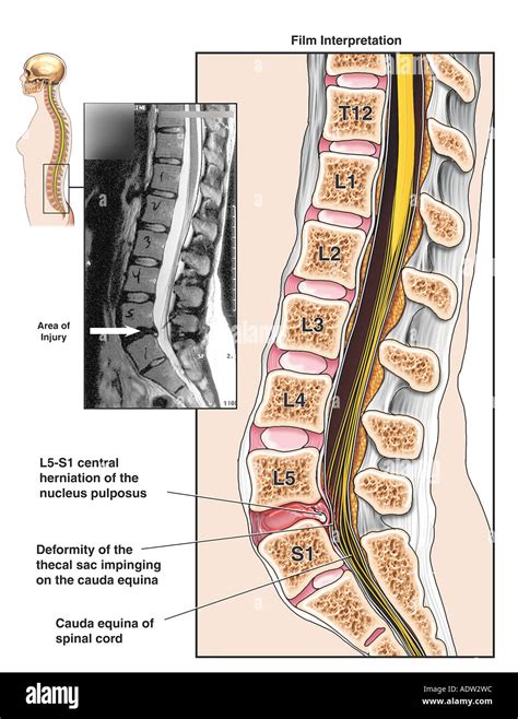 Spinal Cord Injury - L5-S1 Disc Herniation with Compression of Cauda ...