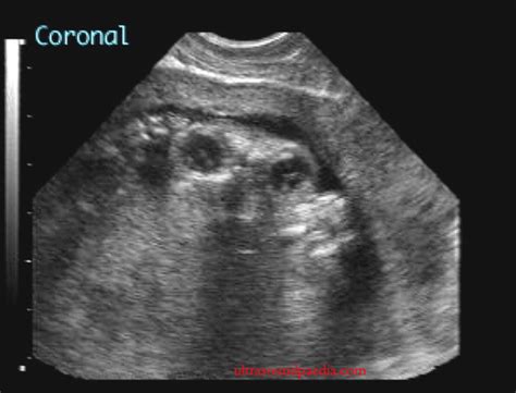 Anencephaly – ULTRASOUNDPAEDIA