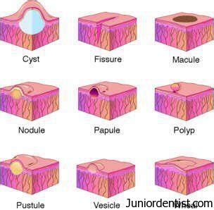 Primary and Secondary Lesions of the Oral cavity