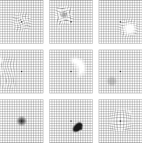 Grid Chart For Macular Degeneration - Printable Worksheets