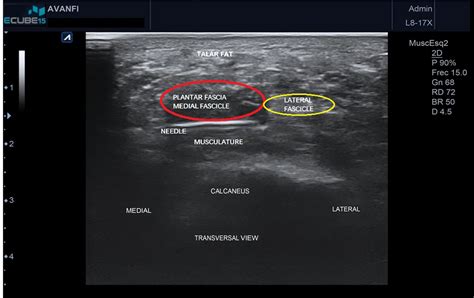 Ultrasound-Guided Plantar Fascia Release with Needle: A Novel Surgical ...