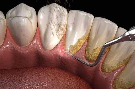 Scaling & Polishing - .: Sunshine Dental