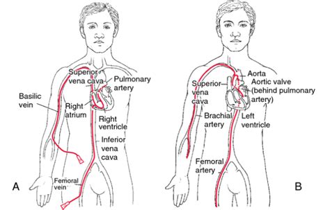 Angiogram (Cardiac Catheterization) - Edmonton Cardiology Consultants