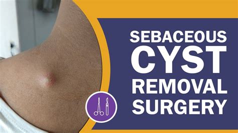 What Are Sebaceous Cysts And How To Treat Them San Diego, 51% OFF