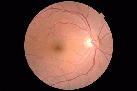 Normal Fundus image - Retina Image Bank