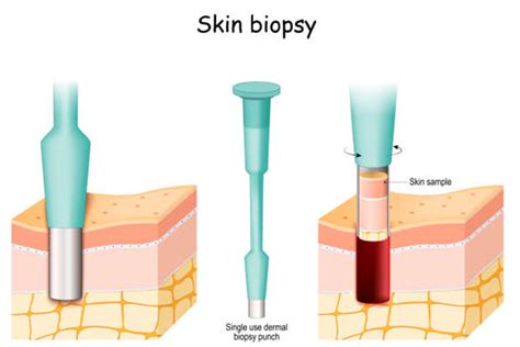 Skin biopsies: what to expect - Thumbay University Hospital