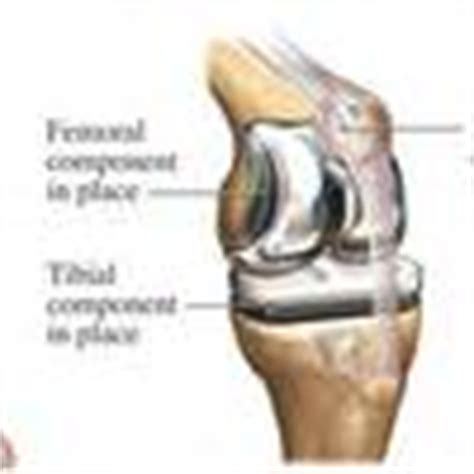 23: Partial Knee Replacement Recovery Time Los Angeles ...