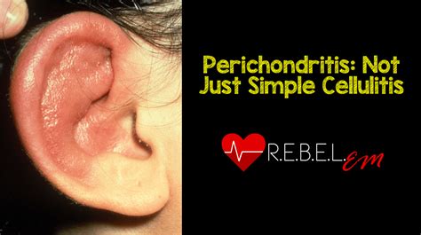 Perichondritis: Not Just Simple Cellulitis - REBEL EM - Emergency ...