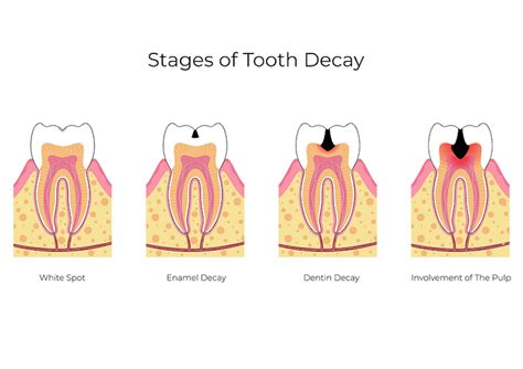 The Five Stages of a Cavity - General Dentistry | St. Mary's Dental