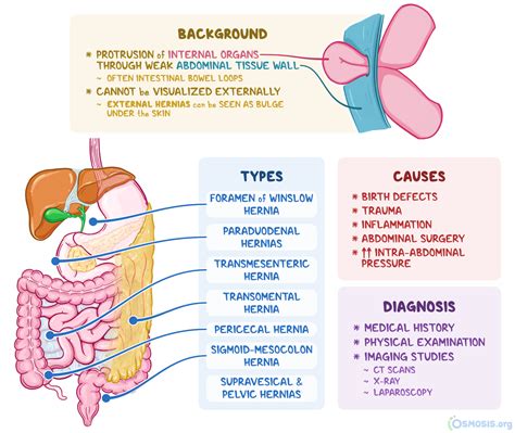 Internal Hernia: What Is It, Rupture, Causes | Osmosis