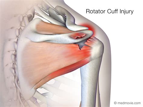 Rotator Cuff Tear Surgery