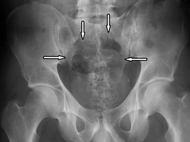 Giant Cell Tumor | Radiology Key