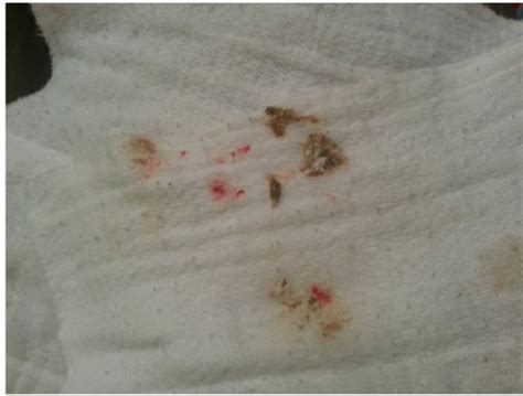 Blood in spit-up? *pic* | BabyCenter