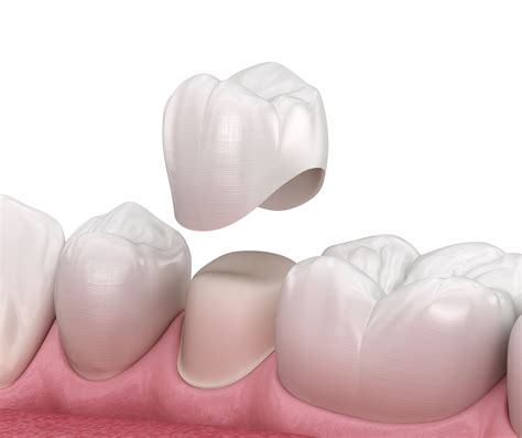 How Dental Cement Works To Hold Crowns In Place | Mercer Island Dental